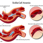 Diagram of red blood sickle cell